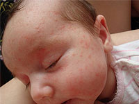 Cosa potrebbe essere un'allergia da un bambino?