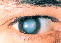 cataract symptoms and the nature of the disease