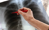 Symptomer på atypisk lungebetændelse