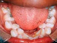 Dentes de Superfluxo ou Hipertone: O que é isso?