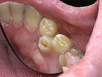 Mi a teendő a felesleges fogakkal?