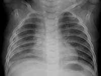 Рентгенова снимка - плеврит при деца