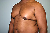 Gynecomastia: Operação nem sempre é necessário!