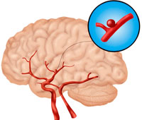 Tuttu muukalainen & mdash; aivojen alusten aneurysm