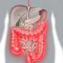 Crohn's Disease Symptoms and Treatment