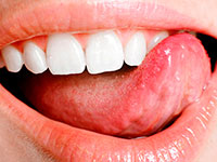 Estágios e causas de pedras dentárias