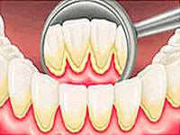 Становни камен зуба, симптоми