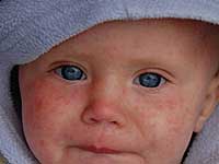 rubella its symptoms in children