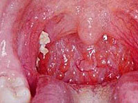 breath chronic tonsillitis