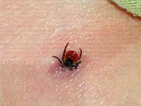 Ticks and human diseases