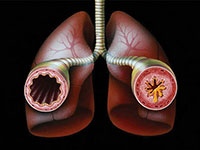 Дијагноза бронхијске астме као резултат инфекције и алергија