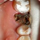 caries under the crown doctor error or violation of hygiene
