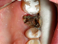 caries under the crown doctor error or violation of hygiene