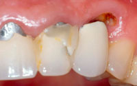 The most common mistakes in the treatment of caries