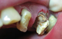What is dangerous root caries and how to treat him?