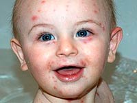 signs of rubella in children