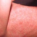 rubella disease that you know about it
