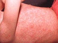 rubella disease that you know about it