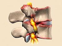 Što je osteoartritis cervikalnog odjela i njezine posljedice