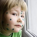 chickenpox during pregnancy than it threatens the fetus