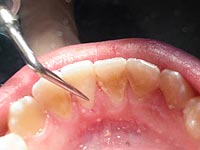 Removemções e opiniões mecânicas de remoção dental
