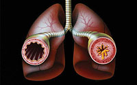 Farlig sygdom - Bronchial Astma
