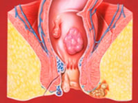 Execiential treatment of internal and external hemorrhoids