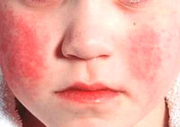 how to recognize scarlet fever in the child's information for parents
