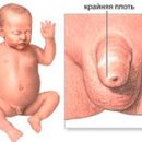balanoposthitis in infants