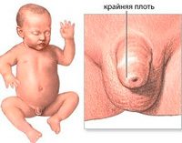 Balanopostitis en niños pequeños