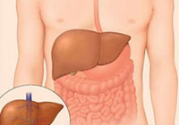 Diffuse liver changes