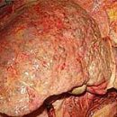 causes of liver cirrhosis