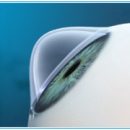 keratoplasty treatment of pathologies of the cornea
