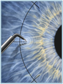 Keratoplasty, treatment of corneal pathologies