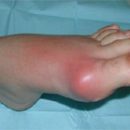 signs and symptoms of gout