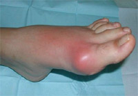 Symptoms and symptoms of gout