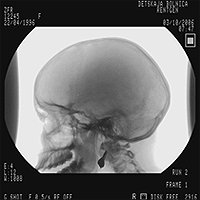 How to recognize pituitary nanice