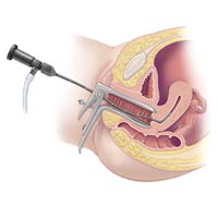 Când o femeie va ajuta laparoscopia?