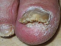 surgical and hardware treatment of nail fungus