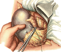 the advantages of laparoscopic splenectomy