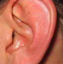 congenital malformations of ear