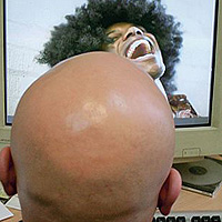 Calvície total e universal como uma forma do ninho alopecia