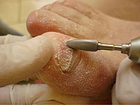 Методе хируршке и хардверске лечења за гљивицу за нокте