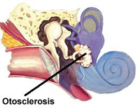 how you can help yourself in otosclerosis