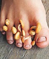 onychomycosis who is to blame and what to do
