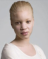 Livet med albinisme eller den mest charmerende og attraktive