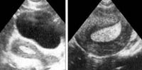 variants endometrial hyperplasia