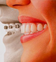 how to care for braces in the mouth
