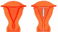 causes endometrial hyperplasia