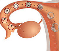 Apoplexia do ovário, sintomas e causas da doença